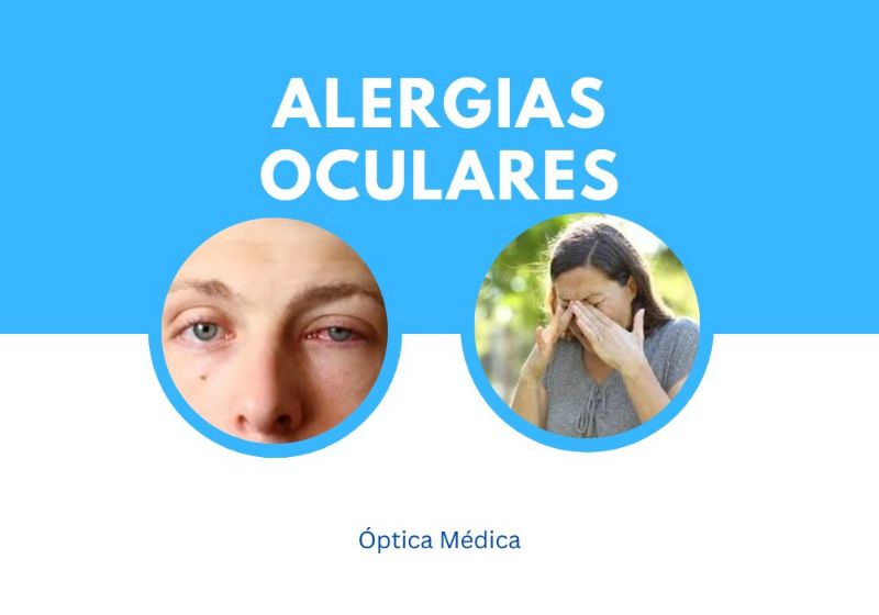 Alergias Oculares